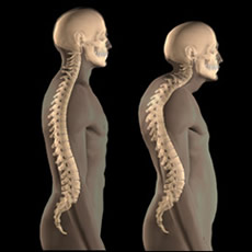 Left: healthy spine. Right: spine with kyphosis and lordosis