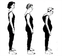 “Shrinking” from poor bone health resulting in kyphosis and lordosis.